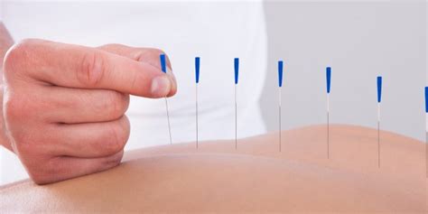 Akupunktur Açlık Duygusunu Düzenliyor Akupunkturun Faydaları Nelerdir