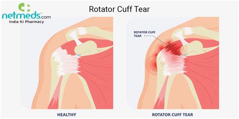 Rotator Cuff Tear Causes Symptoms And Treatment