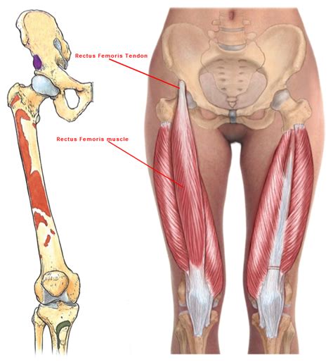It occurs as a result of excessive dynamic load through the tendon; The Rectus Femoris Tendon and Piriformis Syndrome