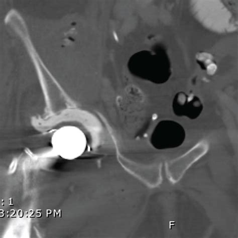 Ct Right Iliopsoas Abscess With Calcifications And Air Arrowhead