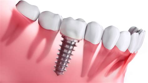 What To Expect During A Dental Implant Procedure Its Advantages