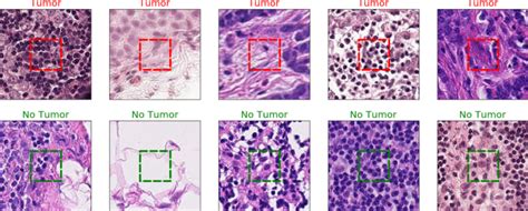 Convolutional Neural Network For Detecting Cancer Tumors In Microscopic