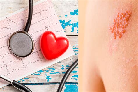 How Shingles May Increase Risk Of Heart Attack And Stroke The Healthy