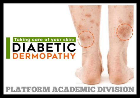 ”diabetic Shin Spots Diabetic Dermopathy” Platform Cme