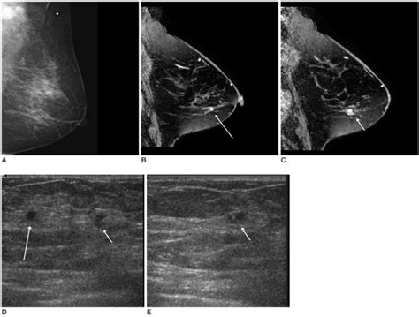 A 78 Year Old Woman With Palpable Left Axillary Lymph Node Metastasis
