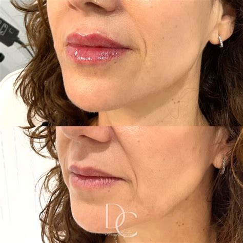Cosmetic Injectables Before And After Gold Coast Dc Aesthetics