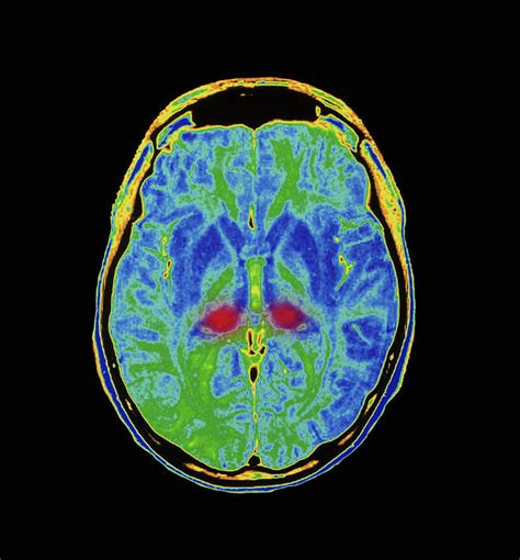 Mri Scan Of Human Brain Diseased With Cjd Photograph By Simon Fraser
