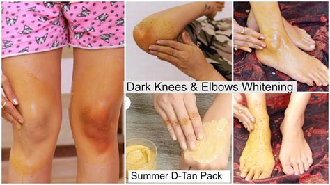 Summer Most Effective Dark Knees And Elbows Whitening Home Remedy