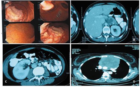 Gastric Involvement In Patients With Primary Mediastinal Large B Cell