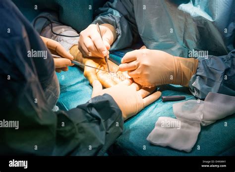 Dupuytrens Contracture Hand Surgery Hi Res Stock Photography And Images