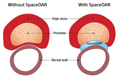 St Lukes Cancer Center Offers Innovative Spaceoar Hydrogel For Prostate Cancer Patients