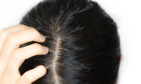 Top Image Seborrheic Dermatitis Hair Loss Thptnganamst Edu Vn