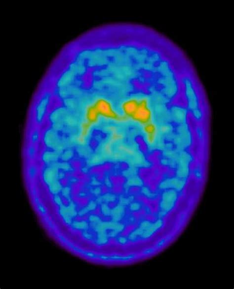 Positive 18 F Dopa Pet Scan In A Patient Suspected Of Having Pd The