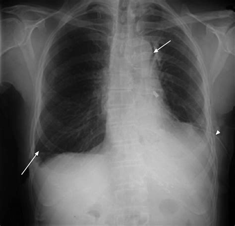 Bilateral Pneumothorax Resulting From A Diagnostic Thoracentesis