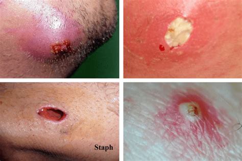 Infected Ingrown Hair Causes Pictures Cysts Staph Treatment