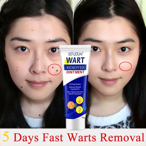 Warts Remover Cream Mole And Warts Remover Warts Magic Remover Wart