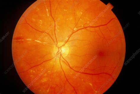 Ophthalmoscopy Of Retinal Embolism In Patient Eye Stock Image M175