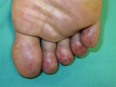 Check spelling or type a new query. Pernio (Chilblains) Article - StatPearls