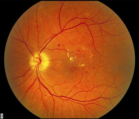 Diabetic Retinopathy An Update On Treatment The American Journal Of