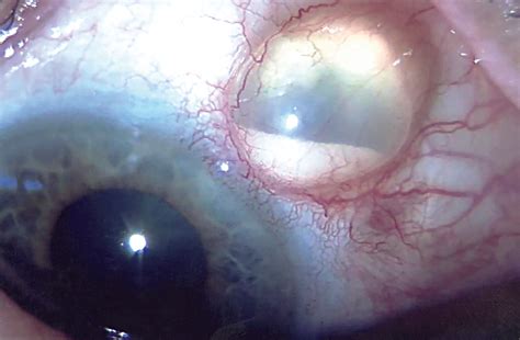 Conjunctival Inclusion Cyst Following Pars Plana