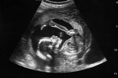 Pregnancy Confirmation Ultrasound The Pregnancy Help Center Of