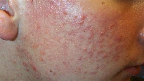 Skin Disorders Pictures Causes Symptoms Treatments Richmond Hill