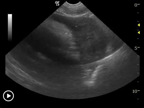 Ultrasound Guided Pericardiocentesis Sonopath