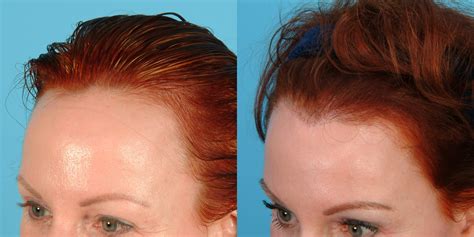 .transplant before and after gallery is a sampling of thousands of successful transplants performed at the hair frontal area and top of scalp. Female Hairline Lowering · Bauman Medical Group