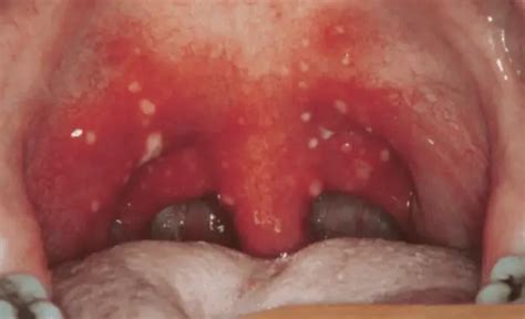 White Spots On Back Of Throat Meaning Cancer No Pain Std Strep Pictures Lump Patches