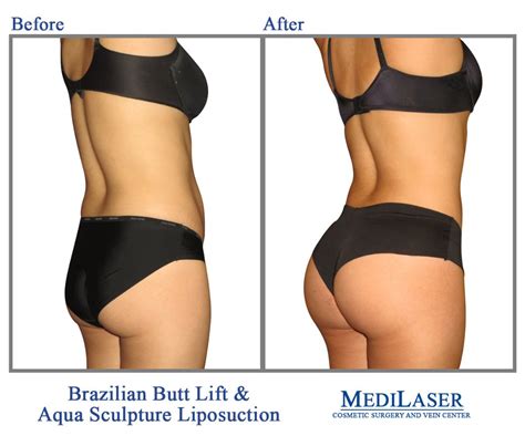Before And After Pictures Of Brazilian Butt Lift Brazilian Butt Lift