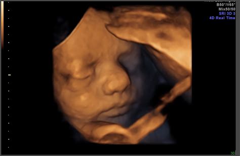 34 Week Fetus In Womb