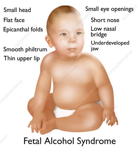 Epicanthal folds are defined as a condition in which skin of upper eyelid show skin folds towards inner corner of eye. Foetal alcohol syndrome baby, artwork - Stock Image C022/6458 - Science Photo Library