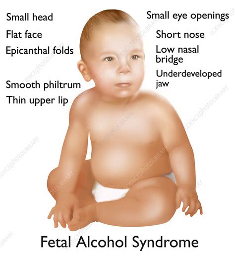 Round face with full cheeks; Foetal alcohol syndrome baby, artwork - Stock Image C022 ...