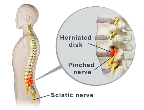Sciatica And Sciatic Nerve Pain Causes And Treatments