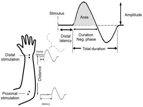 The 25+ best Nerve conduction study ideas on Pinterest