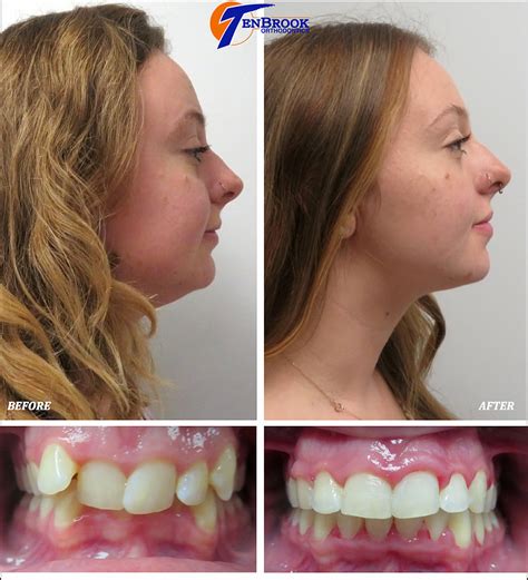 Overbite Lips Before And After Braces