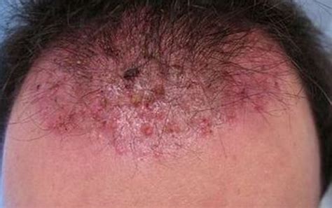 Warmth, redness and tender bumps are also a sign of an infected ingrown hair. Ingrown Hair on Scalp, Head, Cyst, Pictures, Causes ...