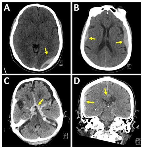 Medical Sciences Free Full Text Neuroimaging Of Traumatic Brain Injury