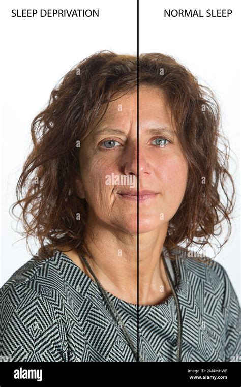 Effects Of Sleep Deprivation On A Womans Face Comparison Before And