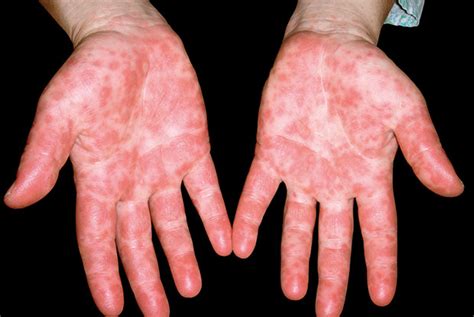 Eczema Coxsackium