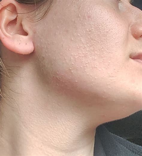 Could This Be Fungal Acne Please Help Im At My Wits End With My