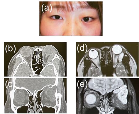 Epidermoid Cyst Of Orbit Requiring Cranialization Of Frontal Sinus