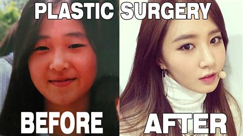Kpop Stars Before And After Plastic Surgery Youtube