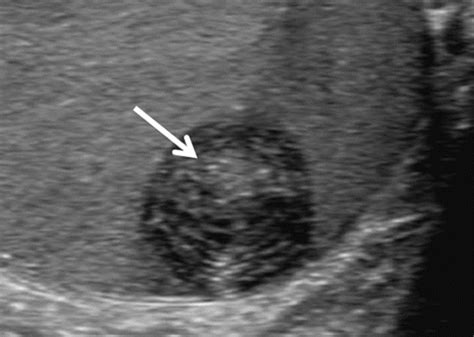 Testicular Tumors What Radiologists Need To Know—differential Diagnosis Staging And