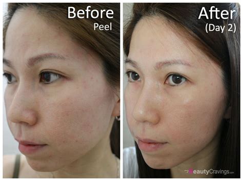 Review At Home 40 Glycolic Acid Peel From Muac Part 2