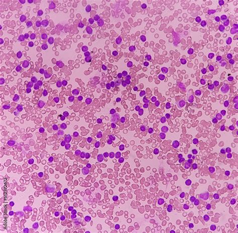 Acute Leukemia Peripheral Blood Smear Show Most Of Cell Are Blast Cell