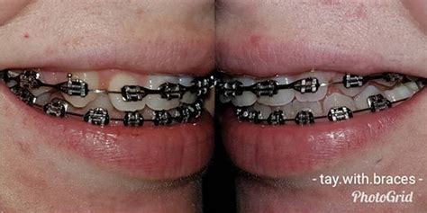 10 Smart Advantages Of Choosing Black Braces Braces Explained