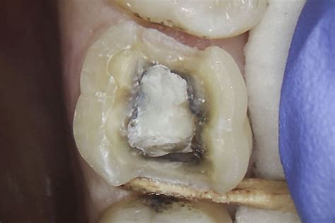 Cracked Tooth Syndrome Amalgam Replacement Rhondium Dental