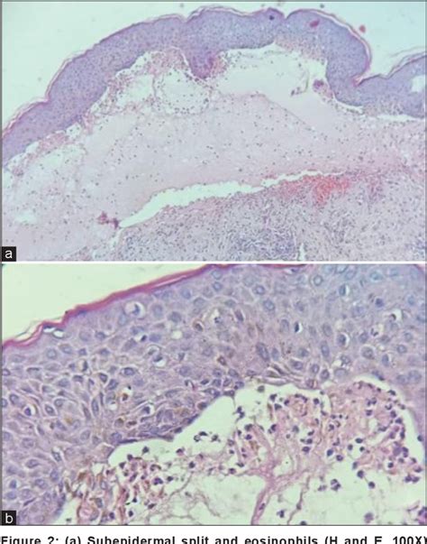 Figure 2 From A Rare Case Of Recurrent Postpartum Pemphigoid