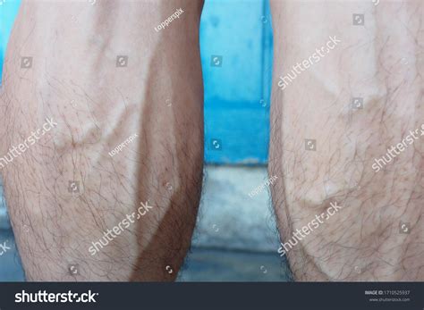 Closeup Bulging Swollen Leg Veins Man ภาพสต็อก แก้ไขตอนนี้ 1710525937